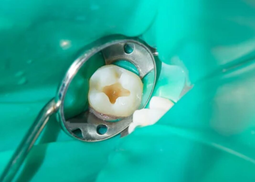 Dinţii deterioraţi ar putea fi reparaţi cu ajutorul plombelor vii