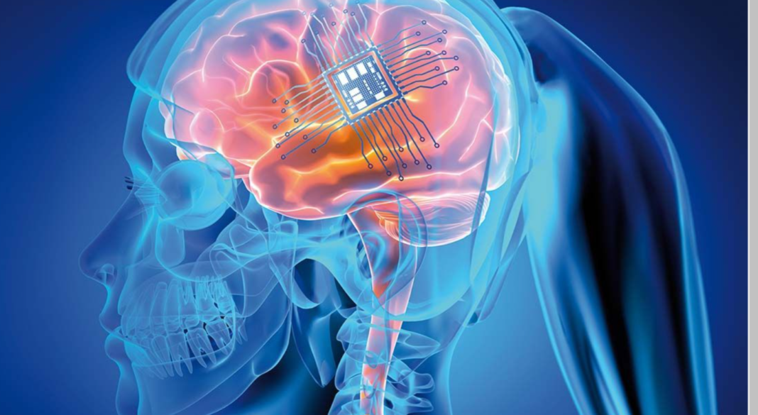 implant cerebral