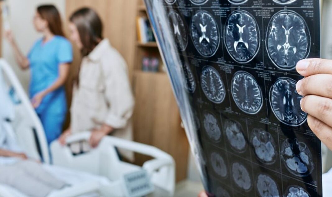 boala Alzheimer, o afecțiune neurodegenerativă devastatoare